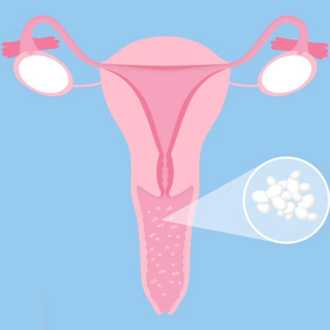 Period Thrush: Understanding the Causes and Finding Natural Solutions - Hey Sister!